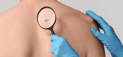 Clicca per accedere all'articolo Evento ECM: MELANOMA: IL PERCORSO MULTIDISCIPLINARE DALLA DIAGNOSI ALLA TERAPIA